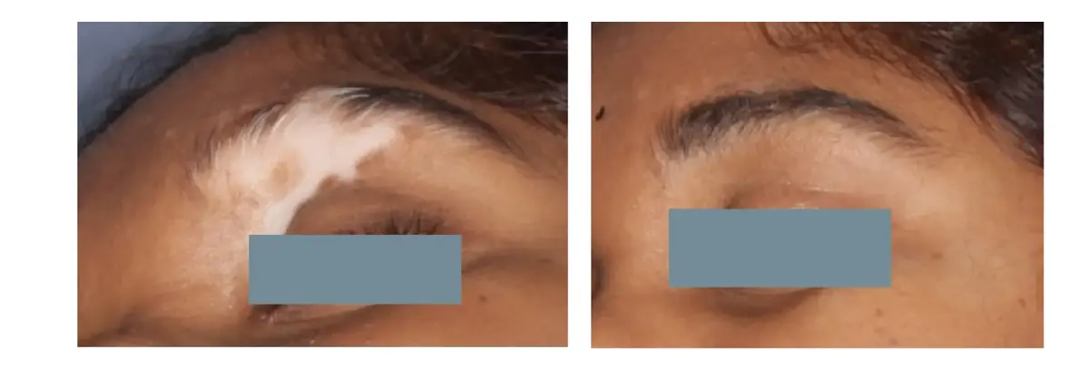 Melanocyte Transplant