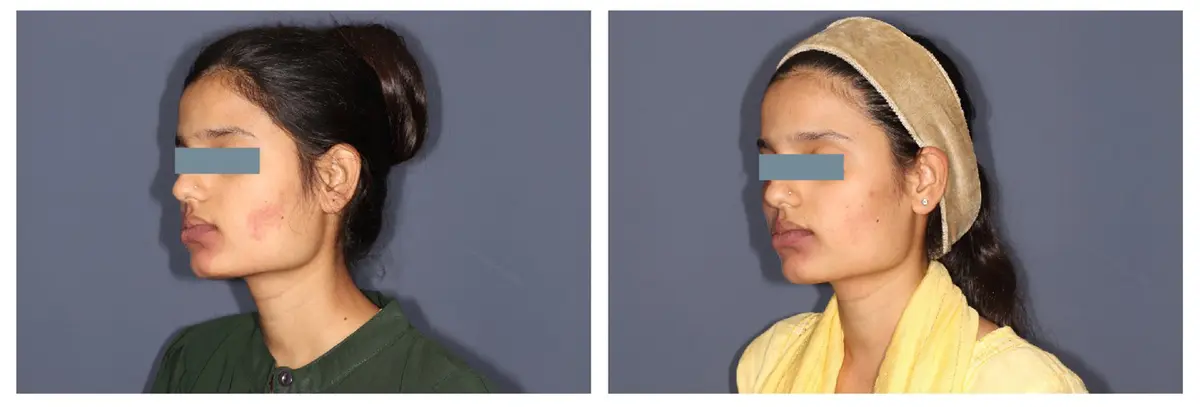 Vascular Birth Marks